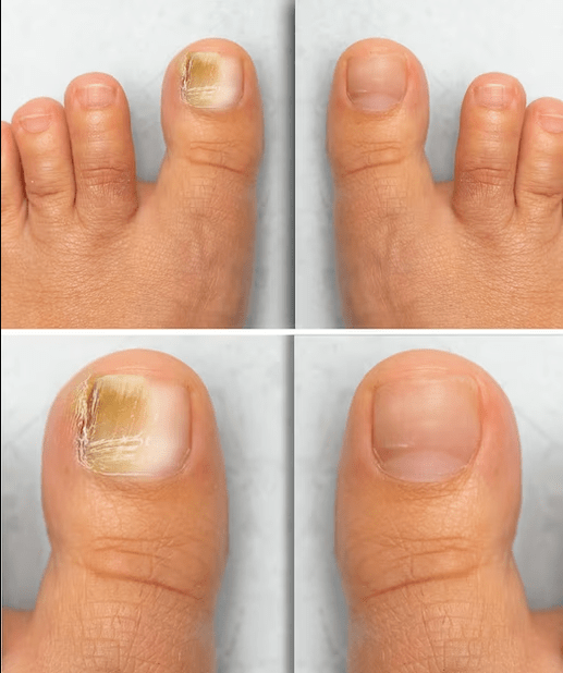 Football Fungi - Before and after treatment with the flint