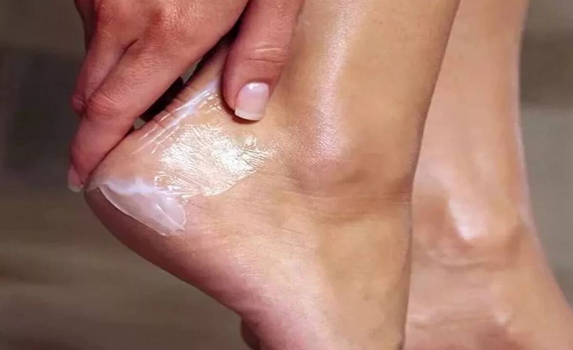 How to treat feet fungus with gripar cream