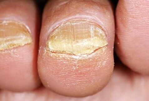 nail fungus symptoms