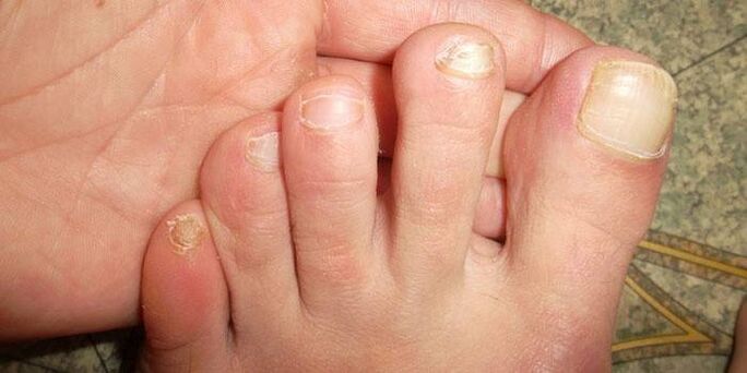 Updating the nail after an injury