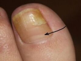 How to recognize the presence of a nail fungus in the thumb