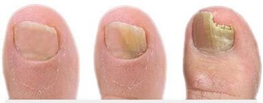 Stages of nail fungal development