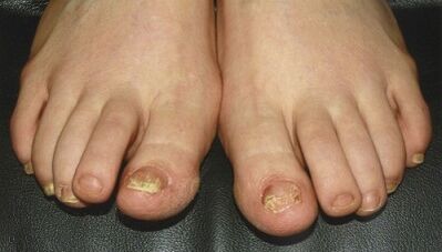 Signs and symptoms of nail fungus