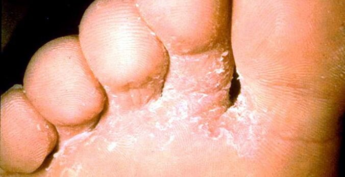 Skin fungus injury between the toes