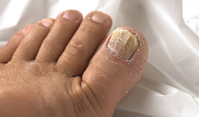 Spread microsa lesion on the nail plate
