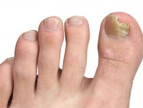 Yellow spots on the nails of the fungus's foot signals