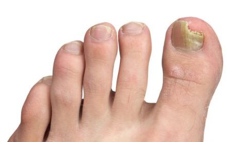 big toe nail fungus