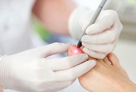 laser treatment for nail fungus