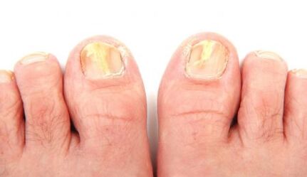 manifestations of nail fungus