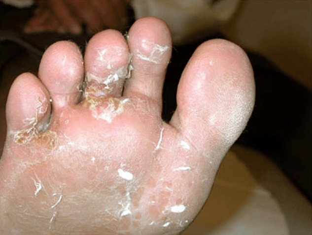 development of fungus on toes