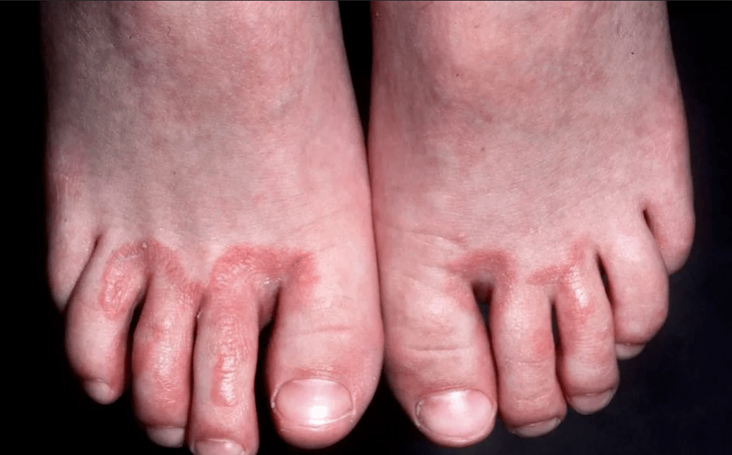 nail fungus complications