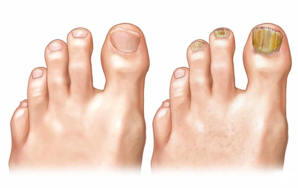 healthy nails and nail fungus