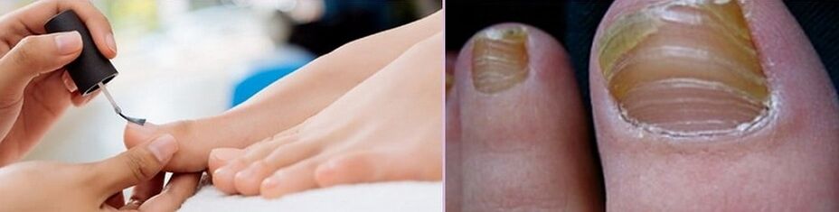 applying varnish to treat fungus