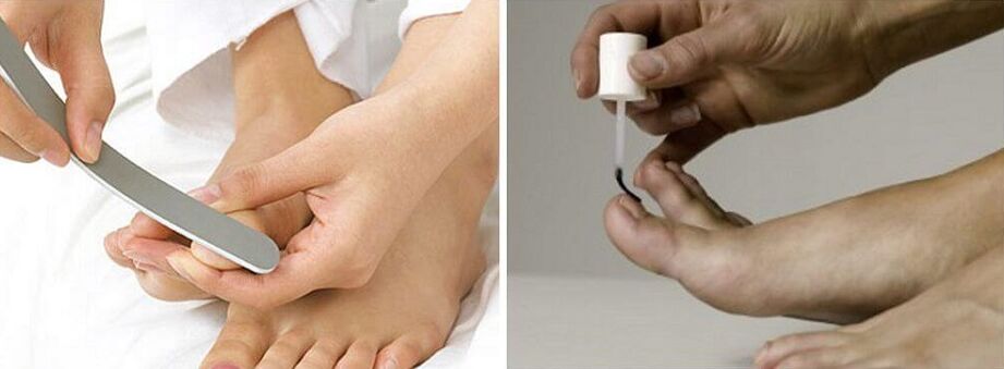 treating toenail fungus with varnish